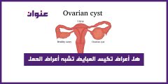 هل أعراض تكيس المبايض تشبه أعراض الحمل