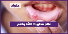 علاج فطريات اللثة والفم