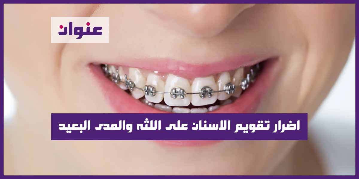 اضرار تقويم الاسنان على اللثه والمدى البعيد