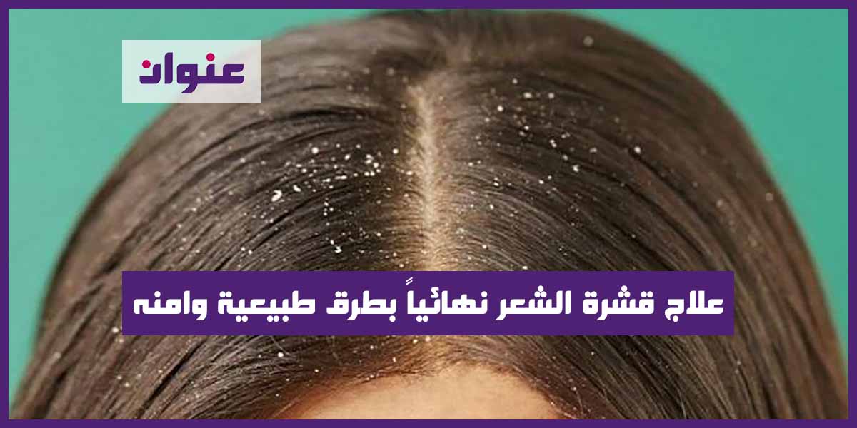 علاج قشرة الشعر نهائياً بطرق طبيعية وامنه