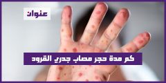 كم مدة حجر مصاب جدري القرود