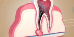 ما علاج التهاب عصب الأسنان 5 وصفات طبيعية رائعة